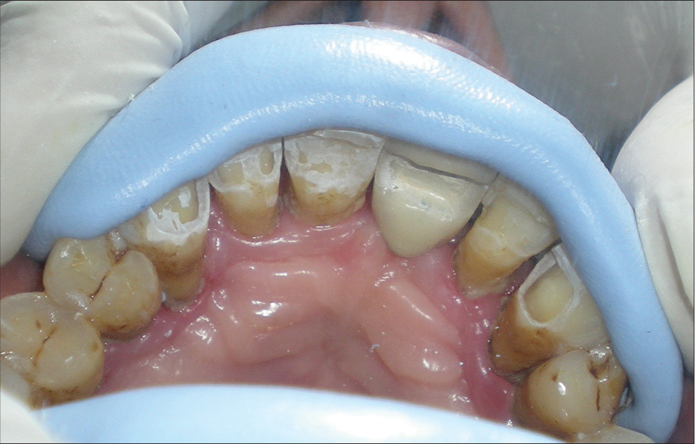 Putty matrix used for stabilization of pontic intraorally.