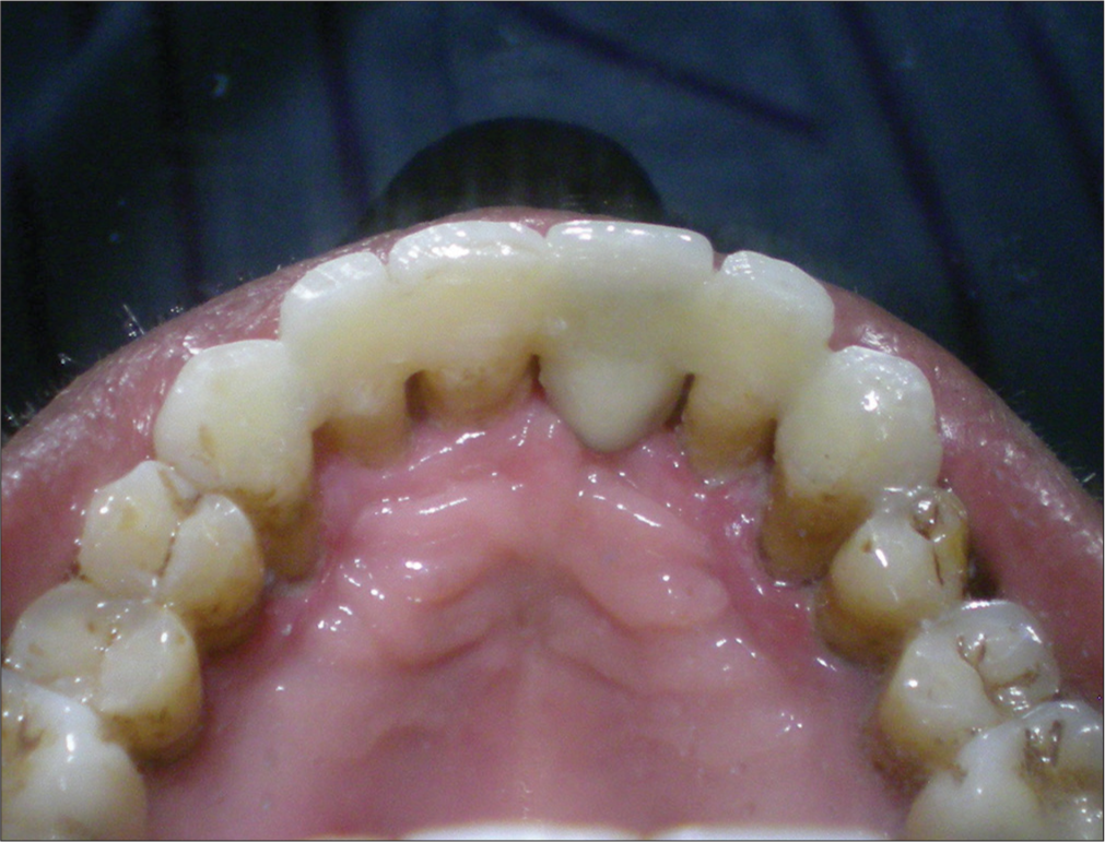 Palatal view of fiber reinforced composite fixed partial denture.