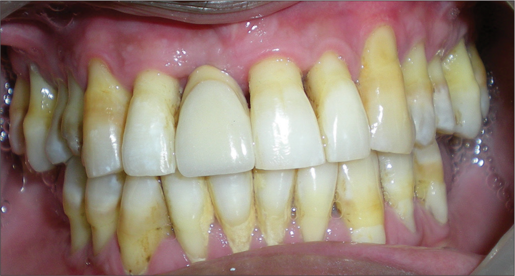 Labial view of fiber reinforced composite fixed partial denture.