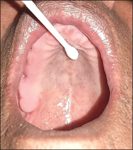 Collection of swab sample from hard palate.