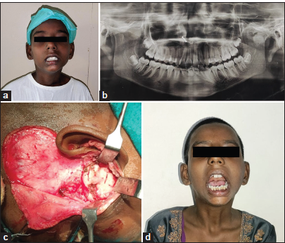 Case 1 (a) Pre-operative profile picture, (b) Pre-operative radiograph, (c) Intra operative image of condylectomy, and (d) Post-operative profile picture.