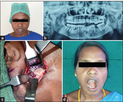 Case 2 (a) Pre-operative profile picture, (b) Pre-operative radiograph, (c) Intra-operative image of internal fixation, and (d) Post-operative profile picture.