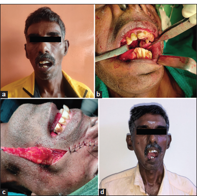 Case 3 (a) Pre-operative profile picture, (b) Intra-operative image of surgical excision, (c) Intra-operative image of nasolabial flap, and (d) Post-operative profile picture.