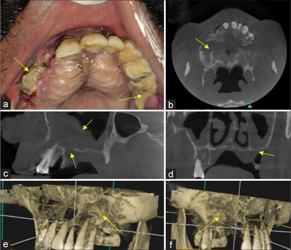 Yellow arrow in (a) Mucormycosis induced osteomyelitis of maxilla showing exposure of underlying necrotic alveolar bone, Yellow arrow in (b) Axial section cone beam computed tomography (CBCT) showing destruction of maxillary alveolar bone, Yellow arrow in (c) Sagittal section CBCT showing mucosal thickening within maxillary sinus and destruction of floor of maxillary sinus, yellow arrow in (d) Coronal CBCT sections revealed destruction of floor of maxillary sinus, yellow arrow in (e and f) 3D reconstructed CBCT images of Maxilla showing destruction of maxillary alveolar bone. Blue lines in (e and f) indicates orthogonal planes.