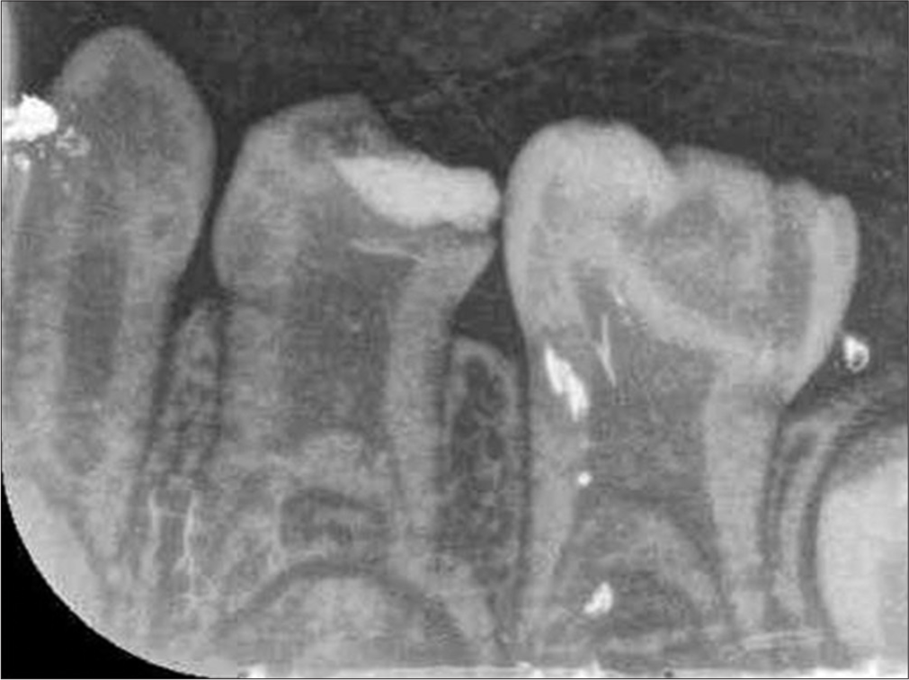 The intraoral radiograph shows deep occlusal caries (75) enlarged pulp chambers and apically shifted bifurcation (74, 75).