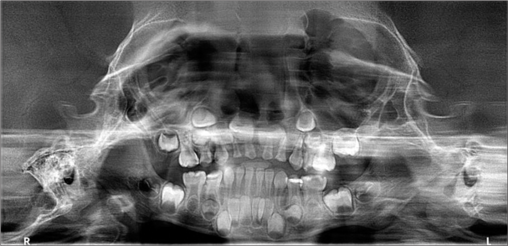 Orthopantomagram revealed an enlarged pulp chamber in all primary molars.