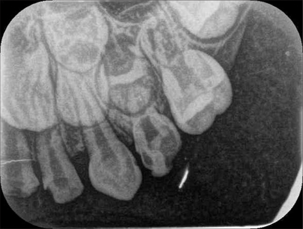 An intraoral periapical radiograph of the 6th quadrant.