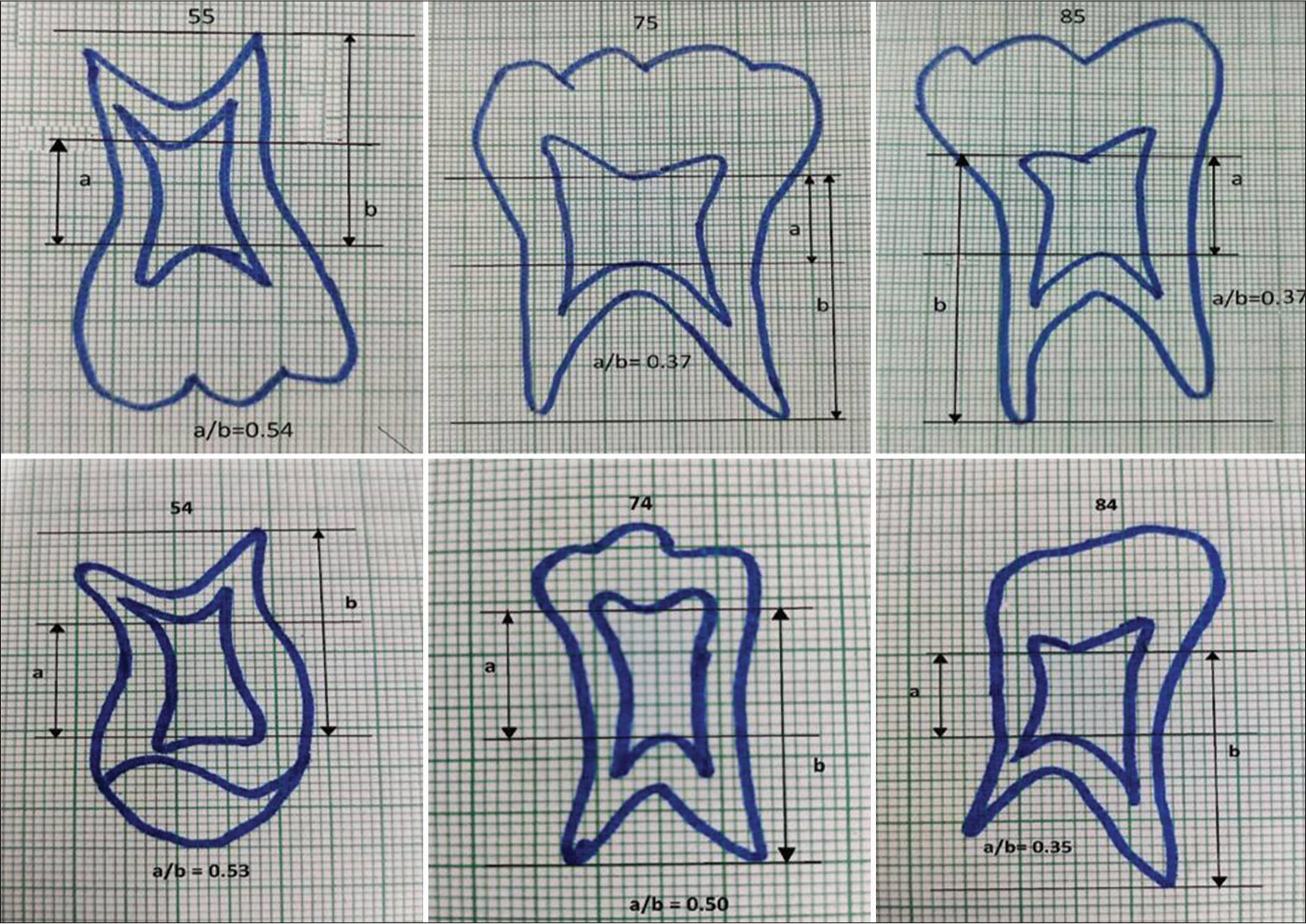 Tracing of the intraoral periapical radiograph showing 74, 75, 84, 85, 54 and 55 confirming the taurodontic tooth according to Shifman and Chanannel criteria.[5]