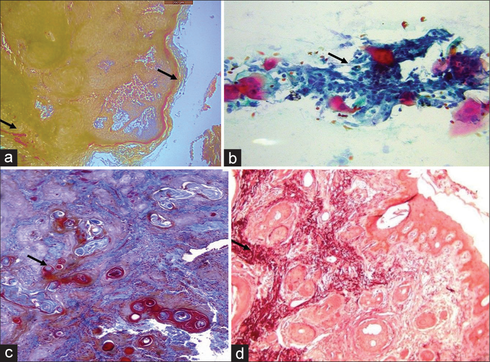 (a) Mallory’s stain shows keratin staining on the surface and within the stroma (Black arrow). (b) Papanicolaou stain of the smear shows neoplastic cells (Black arrow). (c) Masson’s trichrome stain shows invaded neoplastic islands (Black arrow). (d) Shikata’s modified orcein stain shows elastic fibers around the epithelial islands (Black arrow).