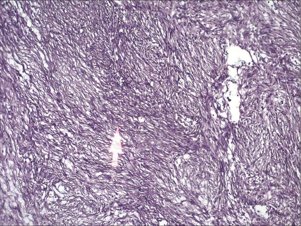 Histopathological picture. (The white arrow signifies the connective tissue area showing interlacing swirls of spindle cells with extravasated Red blood cells).
