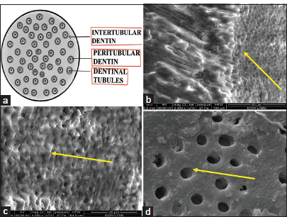 (a) (Digital drawing) T. S of dentinal tubules, (b) scanning electron microscope of L. S and T. S of dentinal tubules, (c) T.S of dentinal tubules, and (d) T.S of dentinal tubules. T.S: Transverse section, L.S: Longitudinal section (b.c,d- structures are denoted by yellow arrows).