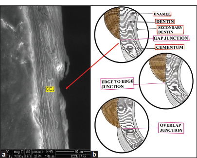 (a) Scanning electron microscope of gap type cementoenamel junction denoted by red arrow (CEJ) in cementum and (b) (Digital drawing) showing three types of CEJ.